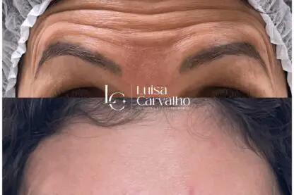 Aplicação de botox em BH