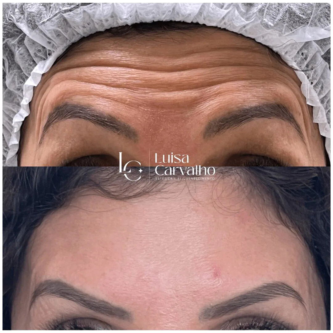 Aplicação de botox