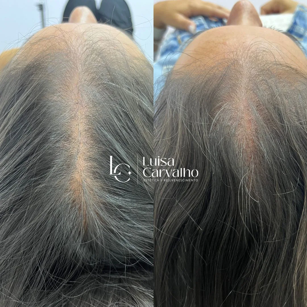 Intradermoterapia